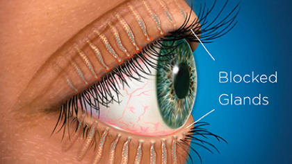eye graphic depicting blocked glands