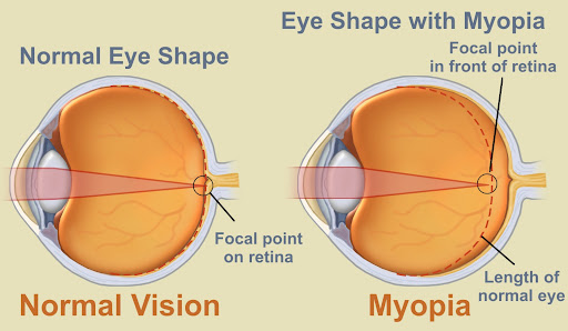 illustration depicting myopia